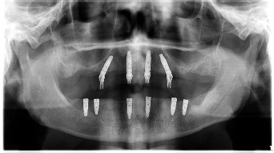 Panoramic dental X-ray showing full-arch All-on implants placed in both jaws