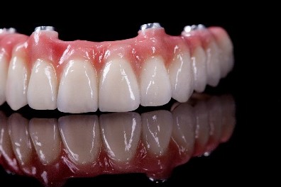 Implant-supported full-arch zirconia bridge with natural-looking gum-coloured base